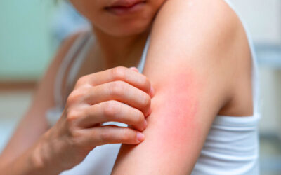 Aumento de sífilis en México alcanza cifras récord en 2025